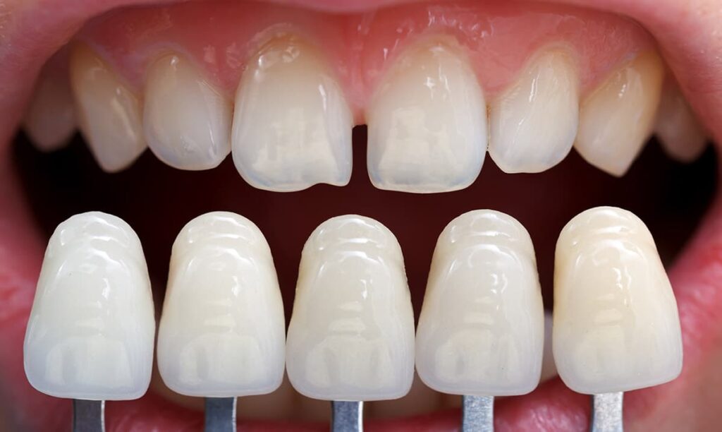shade matching process for dental veneers