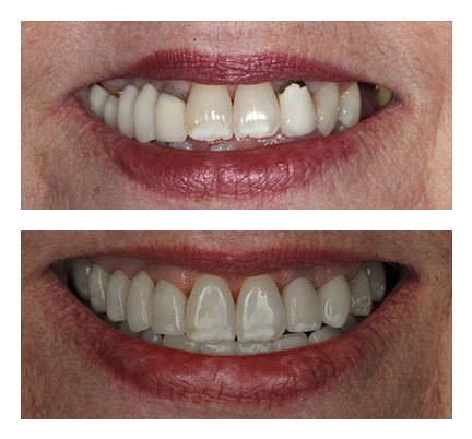 Before and after picture of a full and partial denture patient at North Andover Dental Partners