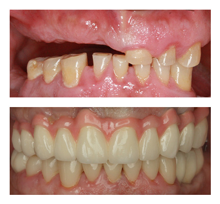 Before and after picture of a full smile makeover patient at North Andover Dental Partners
