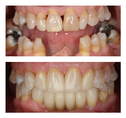 Before and after picture of a dental bridge patient at North Andover Dental Partners