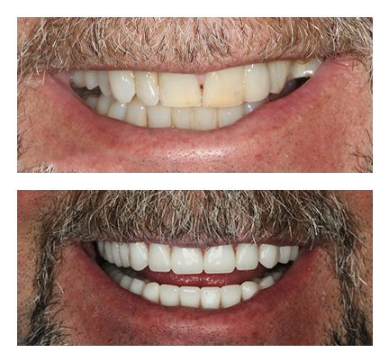 Before and after picture of a dental veneers patient at North Andover Dental Partners