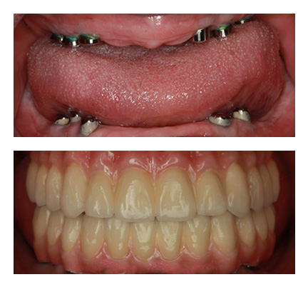 Before and after picture of an implant supported denture patient at North Andover Dental Partners
