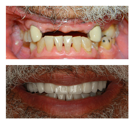 Before and after picture of a cosmetic dentistry crowns and dentures on implants at North Andover Dental Partners