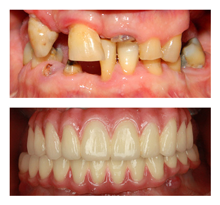 Before and after picture of a full mouth cosmetic reconstruction at North Andover Dental Partners